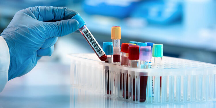 Sample-collector Apprehended Over Charges of ‘Destroying Blood Samples, Embezzlement’ in Pattan